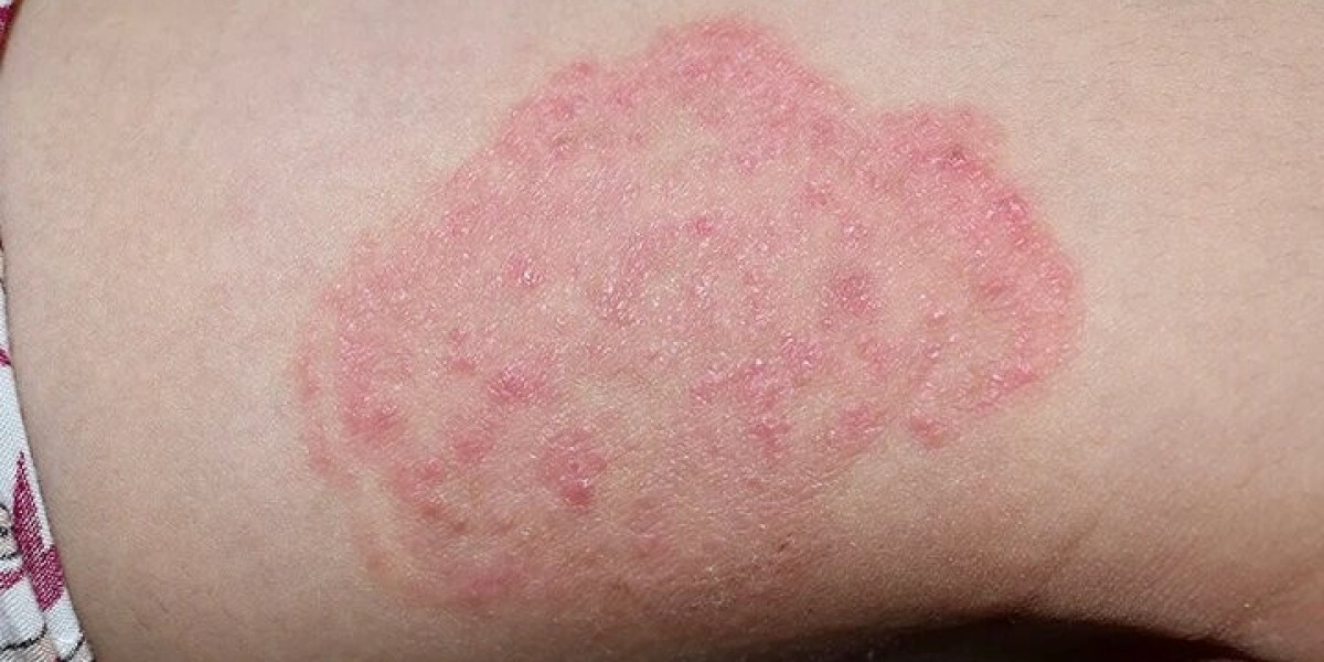 Bacterial skin infection treatment at home